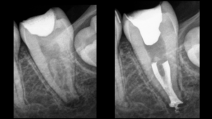 Blog - Dr Brice Riera - Dent permanente immature & endodontie