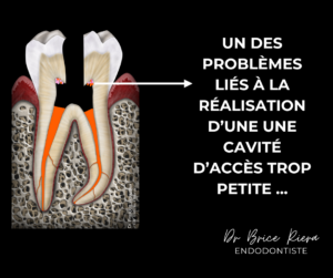 TH - Un des problèmes liés à la réalisation d’une une cavité d’accès trop petite