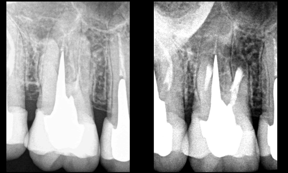 endodontie et microchirurgie - dr brice riera - dentiste paris