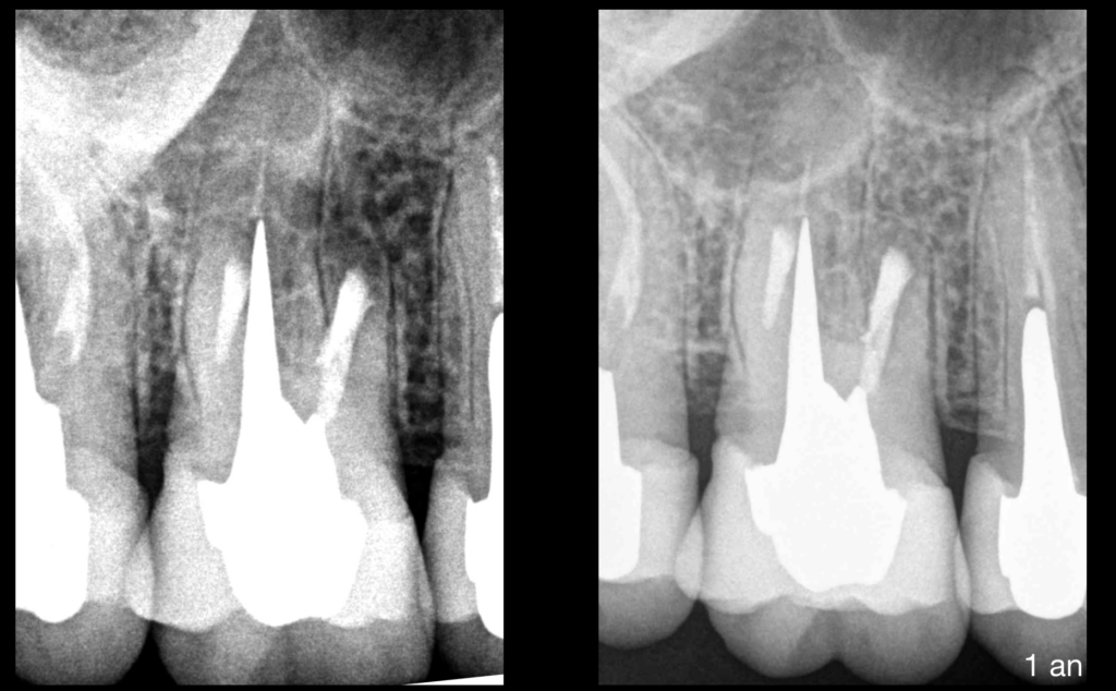 endodontie et microchirurgie - dr brice riera - dentiste paris