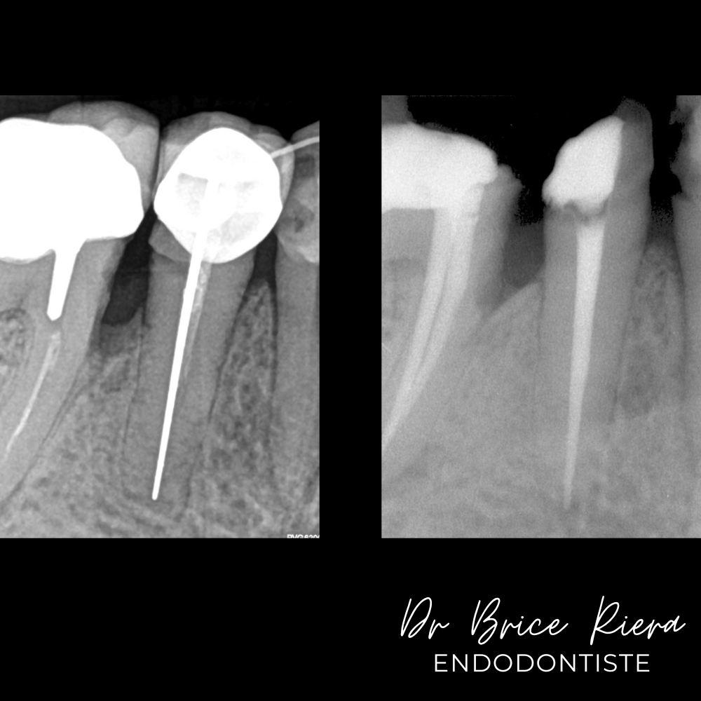 Dr Brice Riera - les cones d argent -4