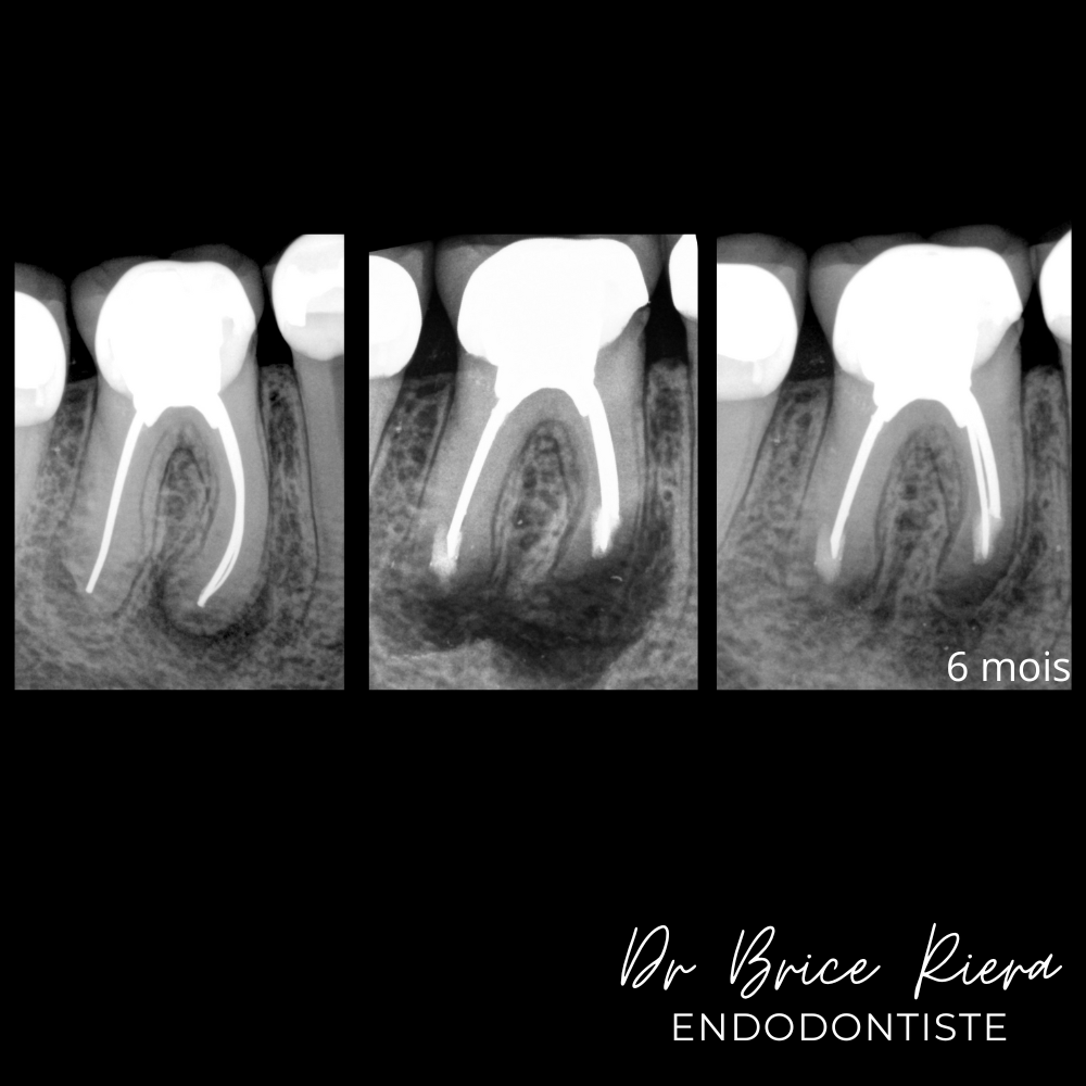 Dr Brice Riera - les cones d argent -5