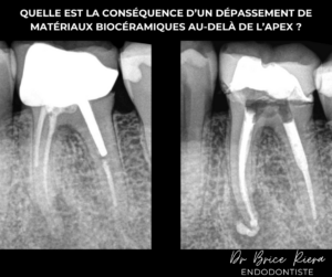 TH - conséquence d’un dépassement de matériaux biocéramique au-delà de l’apex