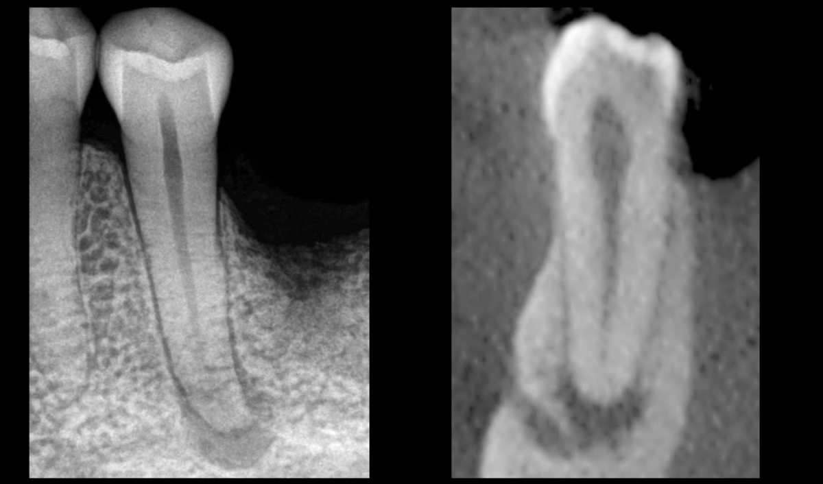 blog - dr brice riera - Décision thérapeutique & endodontie