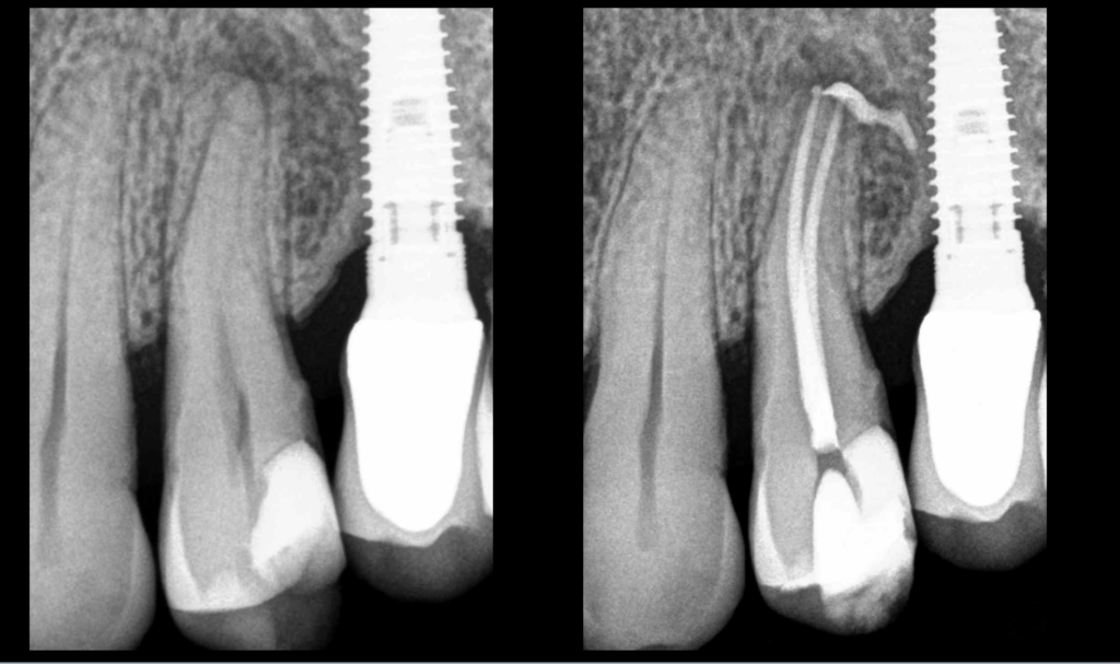 blog - dr brice riera - endodontie et implantologie