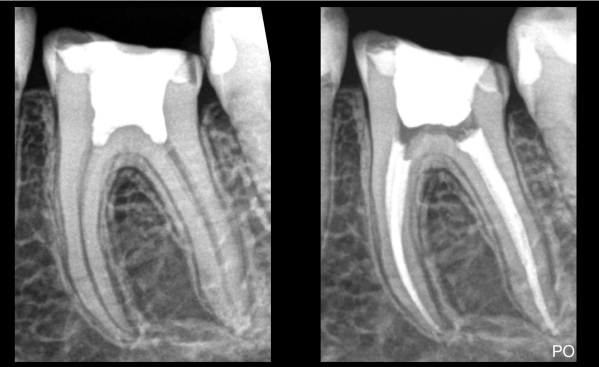 BLOG - Dr Brice Riera - Pulpotomie - Echecs