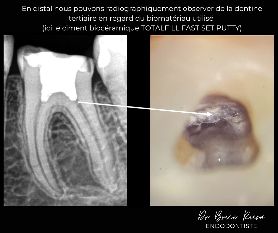 Dr Brice Riera - Endodontiste Paris - Pulpotomie -1