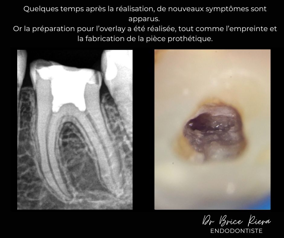 Dr Brice Riera - Endodontiste Paris - Pulpotomie -2