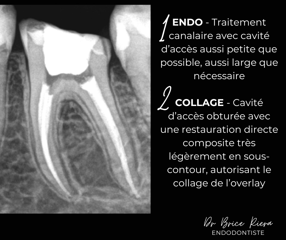 Dr Brice Riera - Endodontiste Paris - Pulpotomie -3