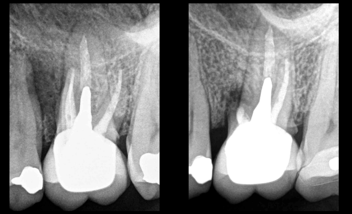 blog - dr brice riera - amputation radiculaire