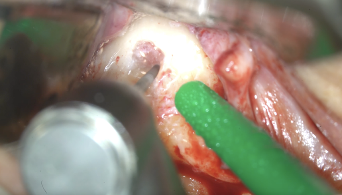 blog - dr brice riera - curetage ou resection apicale