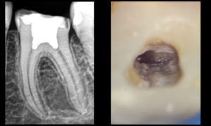 blog - dr brice riera - pulpotomie