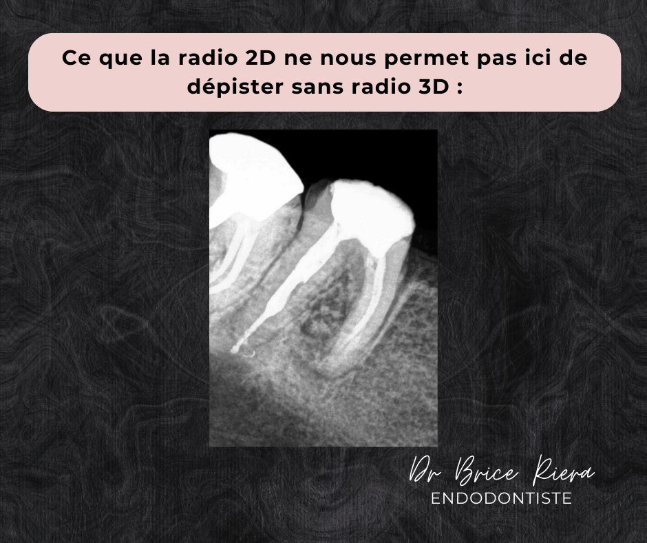 Ce que la radio 2D ne permet pas de depister