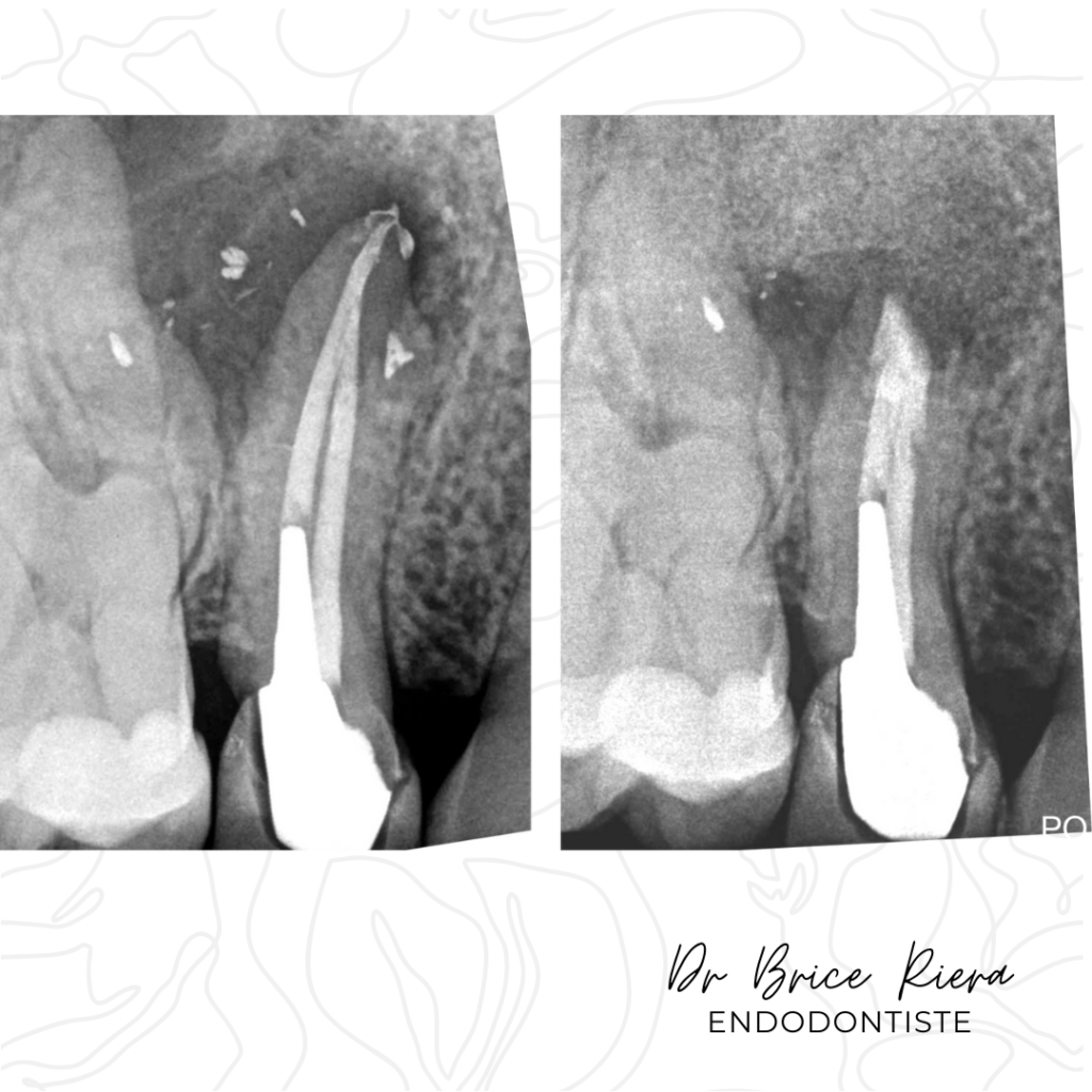 Dr Brice Riera - Lésions Osseuses de part en part