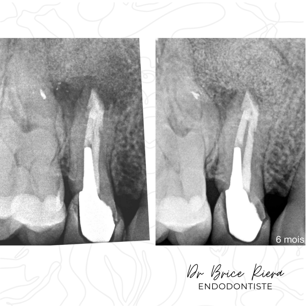 Dr Brice Riera - Lésions Osseuses de part en part