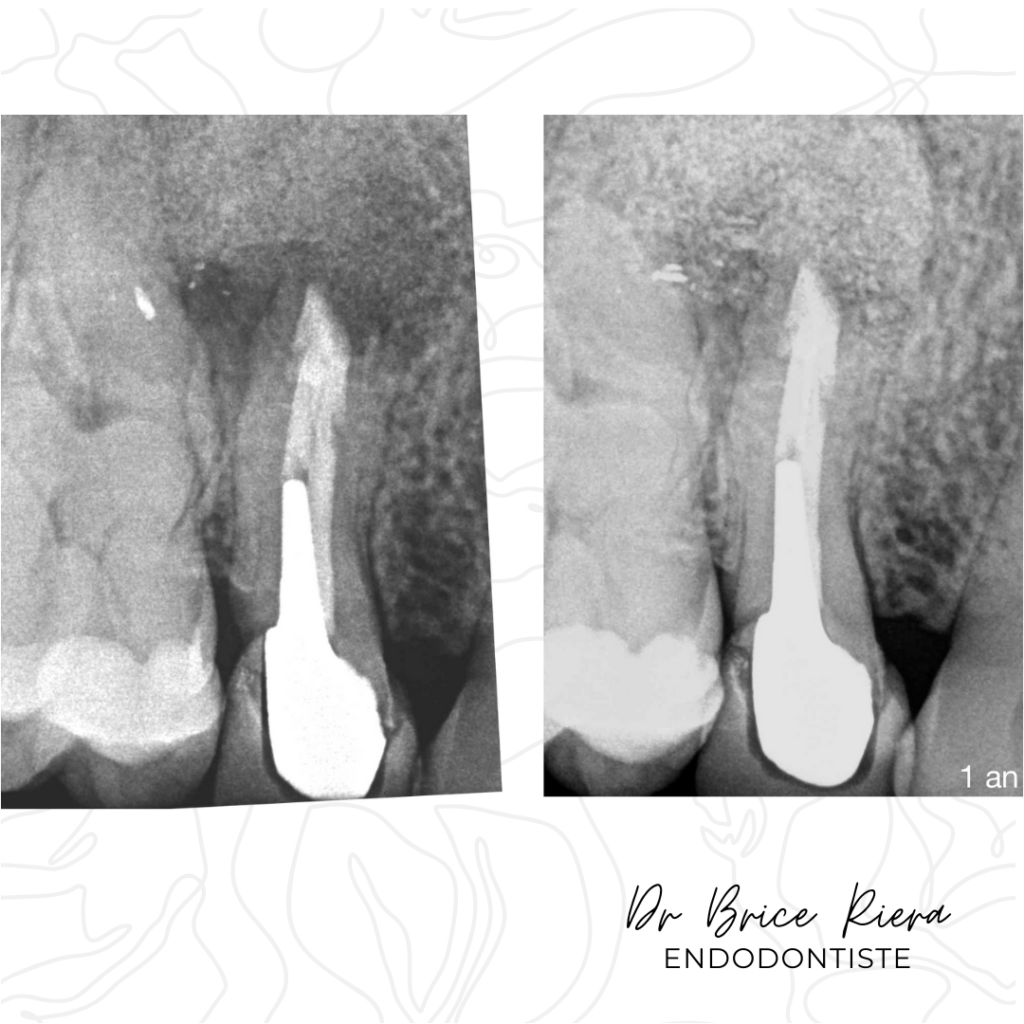 Dr Brice Riera - Lésions Osseuses de part en part