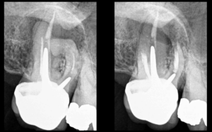 BLOG - Dr Brice Riera - dent n°17 est accessible par chirurgie endodontique