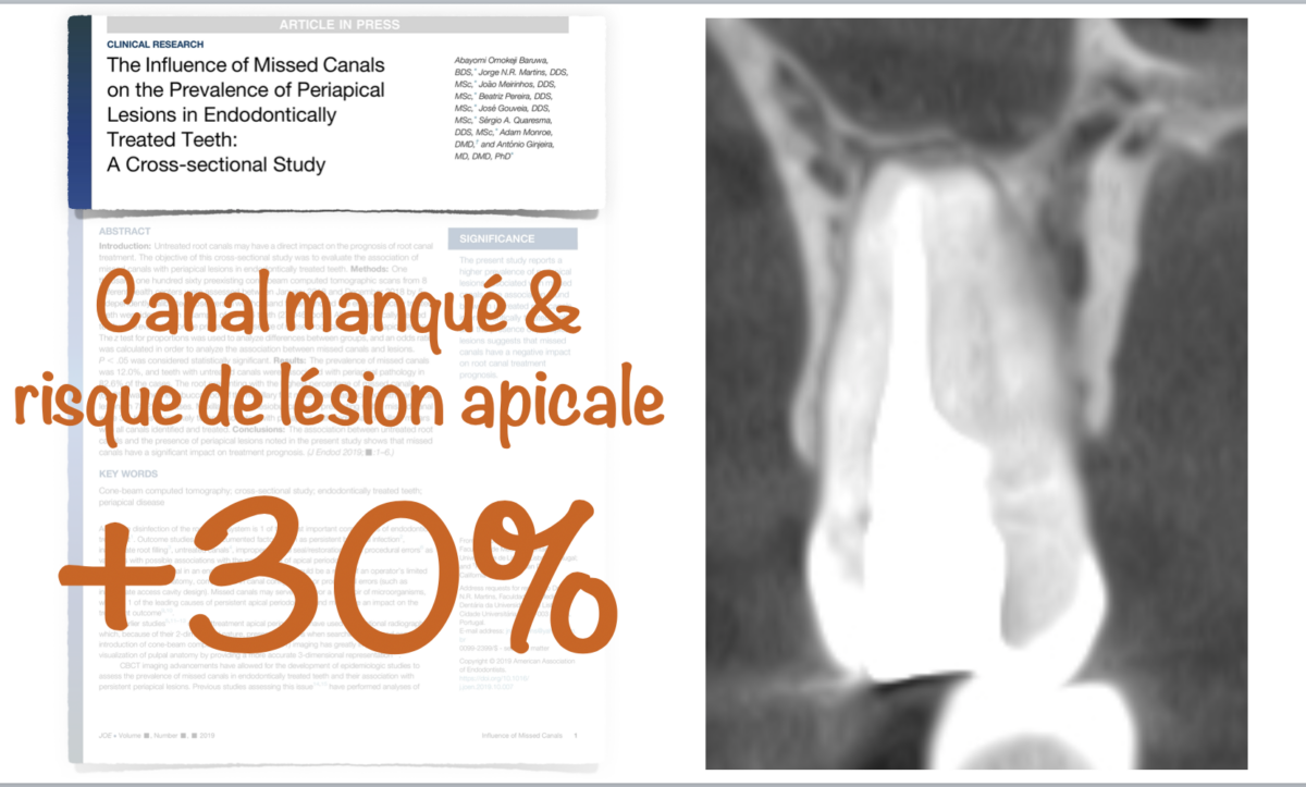 Blog - Dr Brice Riera - Canal manque et risque de lesion apicale