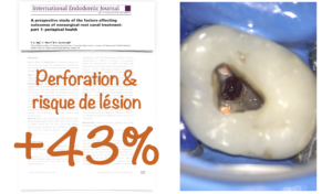 Blog - dr brice riera - perforation et lesion apicale