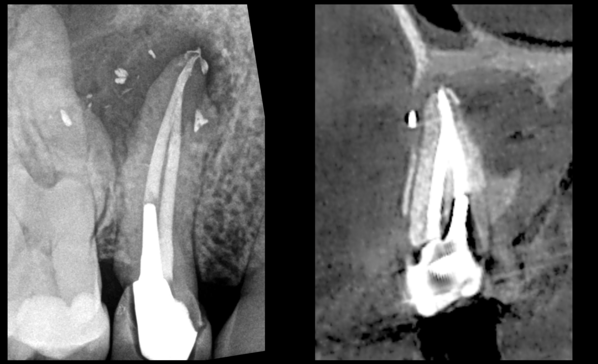 blog - dr brice riera - lesion osseuse de part en part