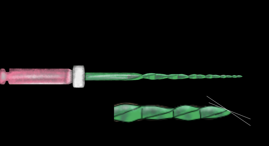 BLOG - Dr Brice Riera - angle de pointe