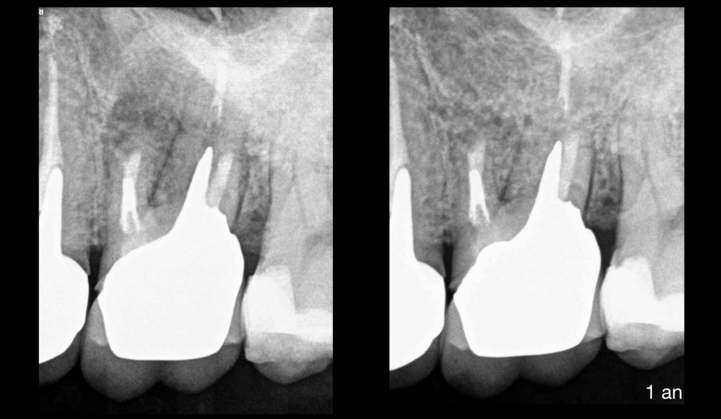 BLog - Dr Brice Riera - pulpe precedemment traitee