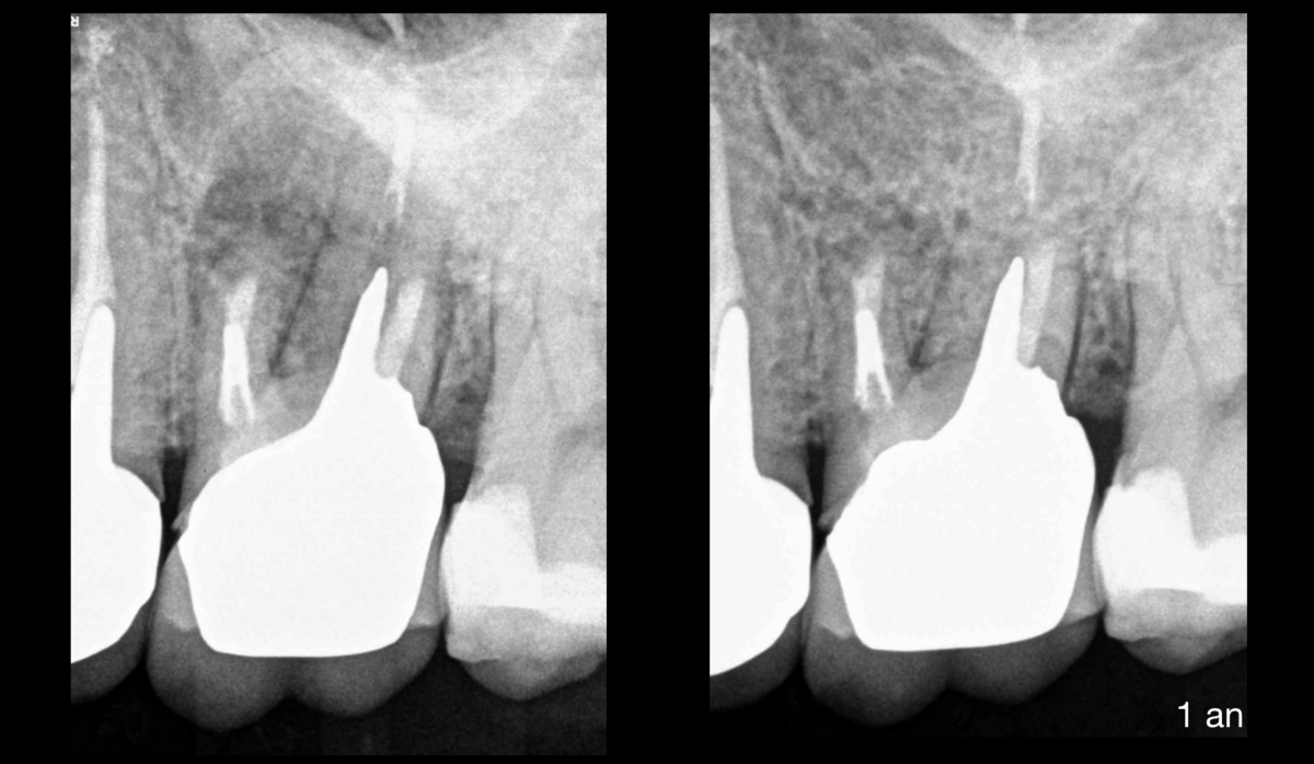 BLog - Dr Brice Riera - pulpe precedemment traitee