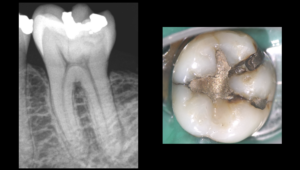 Blog - Dr Brice Riera - pulpe necrosee