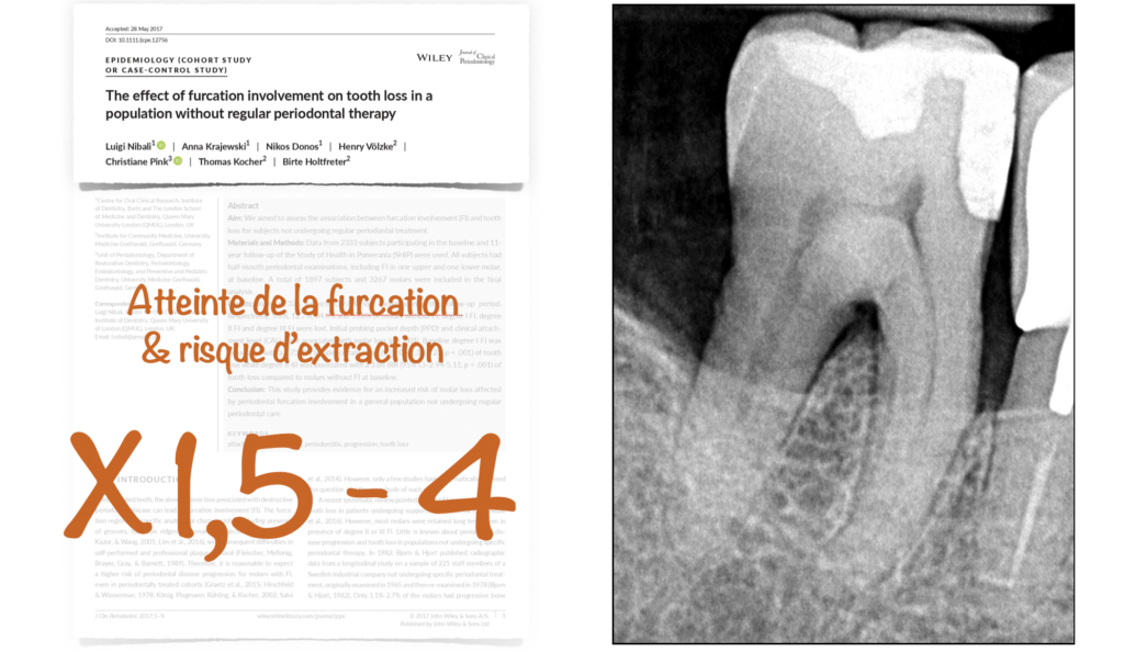 Blog - dr brice riera - atteinte de la furcation