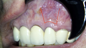 blog - dr brice riera - Incision para-marginale