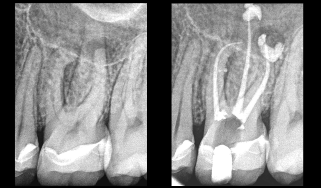 blog - dr brice riera - bioceramique injectee dans le canal