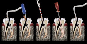 blog - dr brice riera - cavite acces trop petite