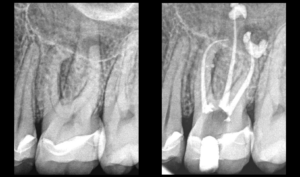 blog - dr brice riera - preuve de desinfection canal