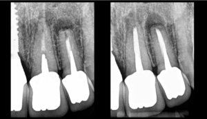 blog - dr brice riera - quelle incision