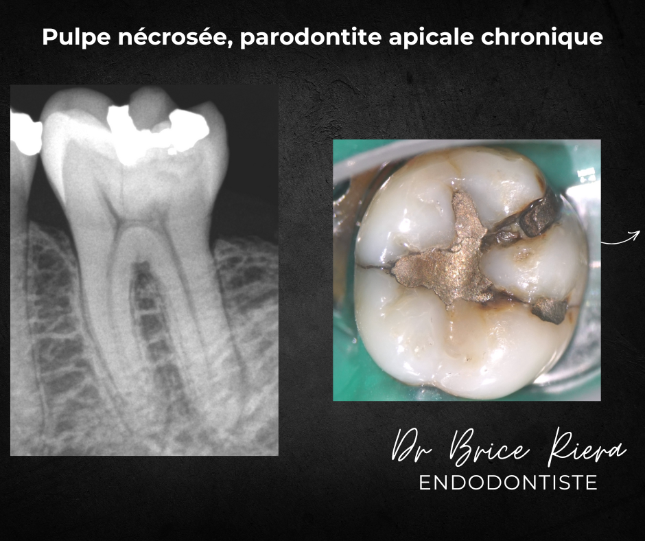 pulpe necrosee - endodontiste - Paris - Dr brice riera1