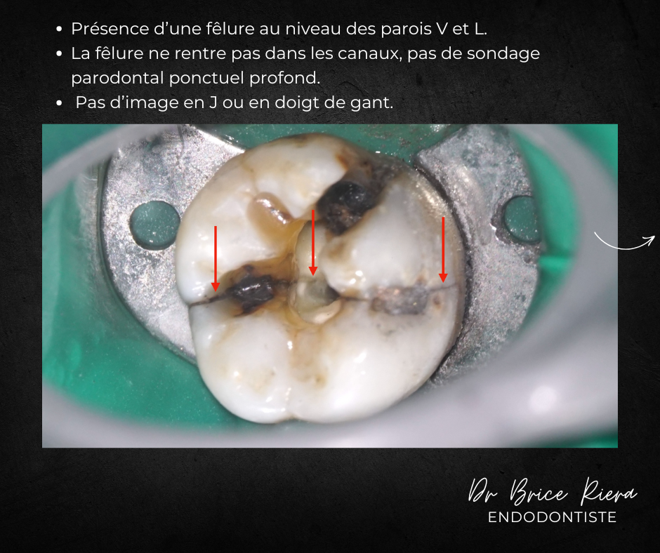 pulpe necrosee - endodontiste - Paris - Dr brice riera2