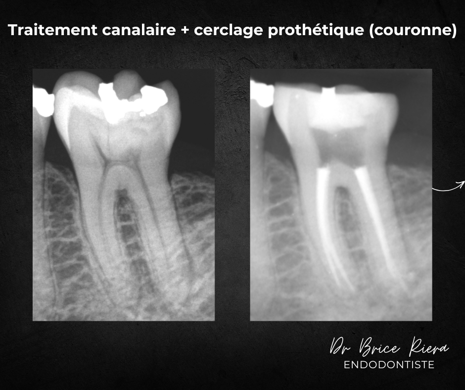 pulpe necrosee - endodontiste - Paris - Dr brice riera3