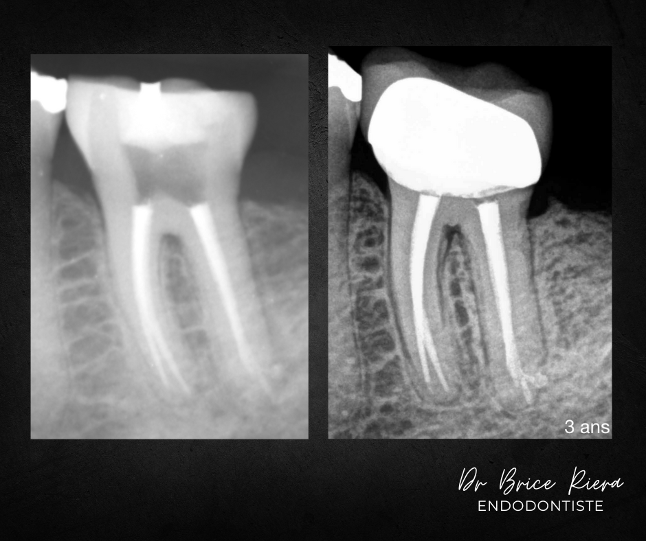 pulpe necrosee - endodontiste - Paris - Dr brice riera4