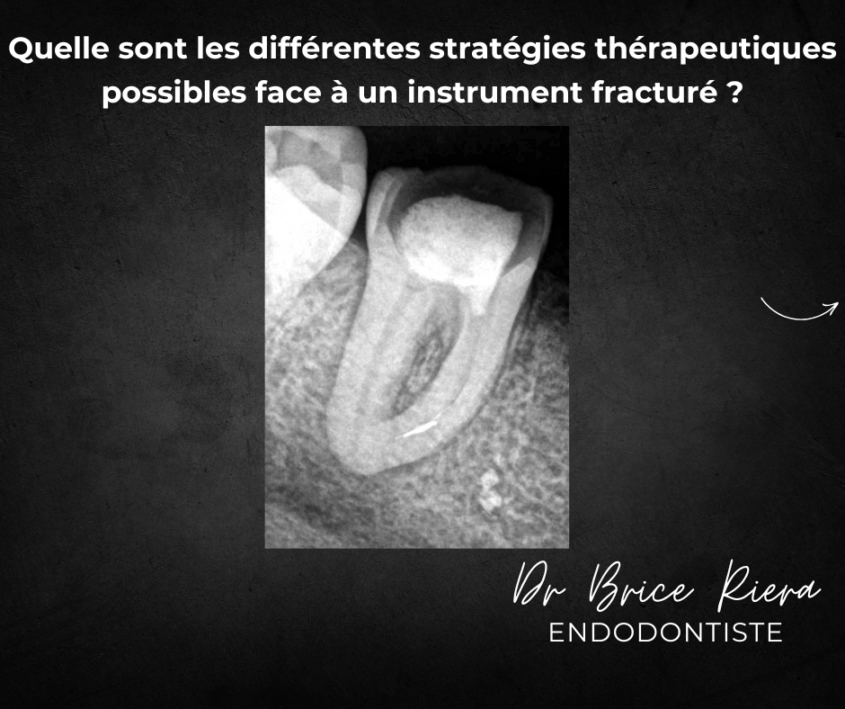 BLOG - Dr Brice Riera - Strategie pour instrument endodontique oublie dans canal