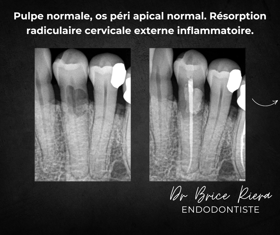 Dr Brice Riera Endodontiste - pourquoi un traitement canalaire 