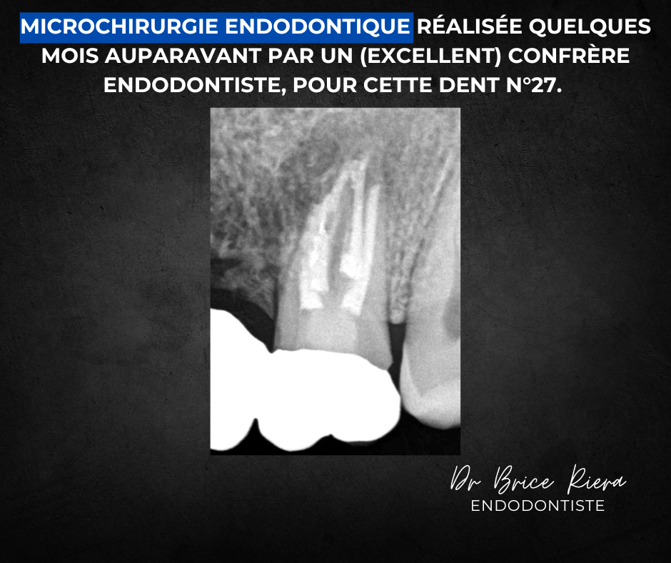 Dr Brice Riera Endodontiste - pourquoi un traitement canalaire - reprise chirurgicale