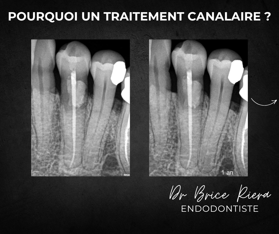 Dr Brice Riera Endodontiste - pourquoi un traitement canalaire 