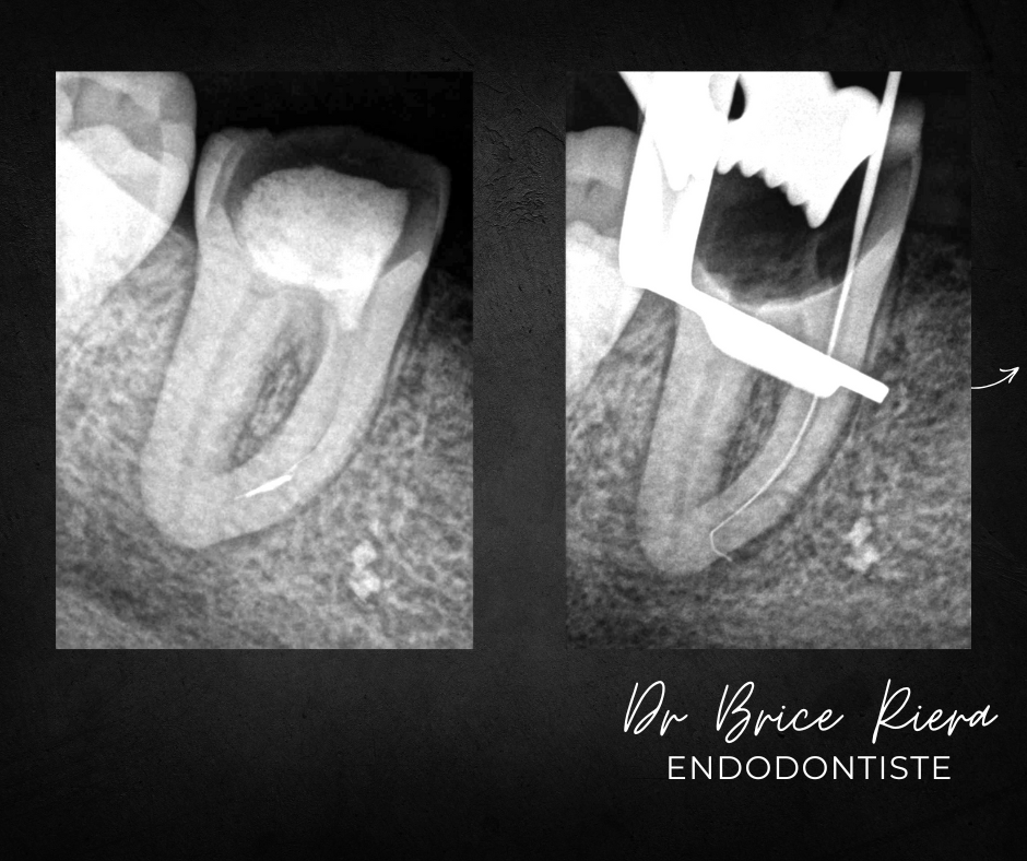 BLOG - Dr Brice Riera - Strategie pour instrument endodontique oublie dans canal