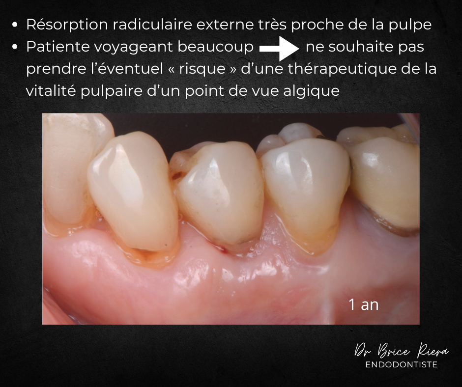 Dr Brice Riera Endodontiste - pourquoi un traitement canalaire 