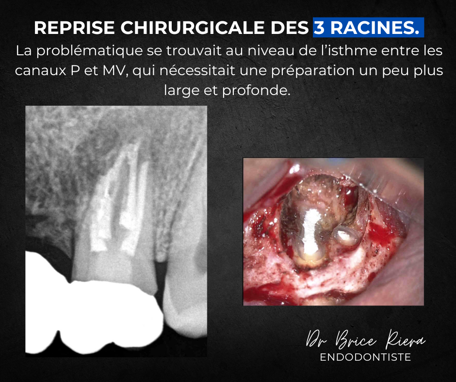 Dr Brice Riera Endodontiste - pourquoi un traitement canalaire - reprise chirurgicale