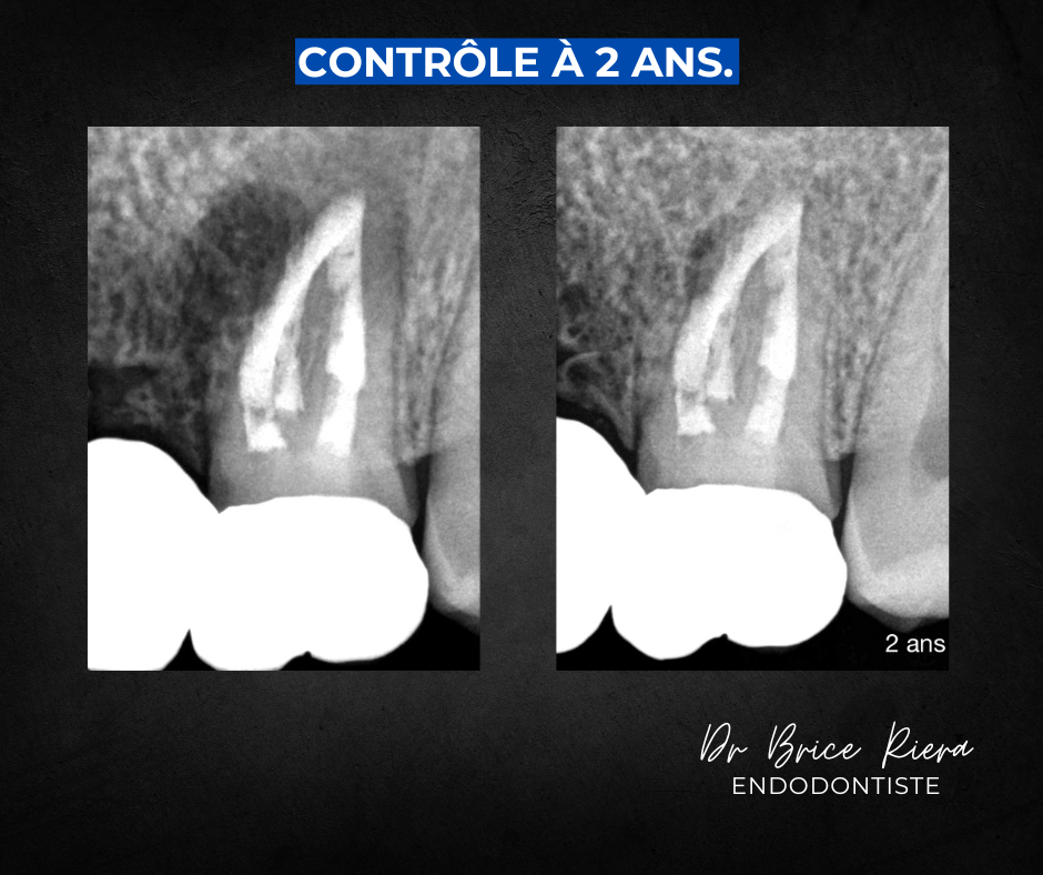 Dr Brice Riera Endodontiste - pourquoi un traitement canalaire - reprise chirurgicale