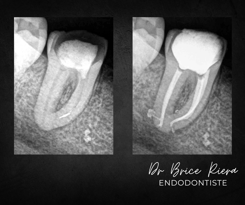 BLOG - Dr Brice Riera - Strategie pour instrument endodontique oublie dans canal