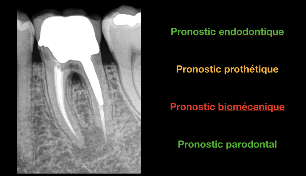 BLOG - Dr BRice Riera - quel pronostic pour cette dent