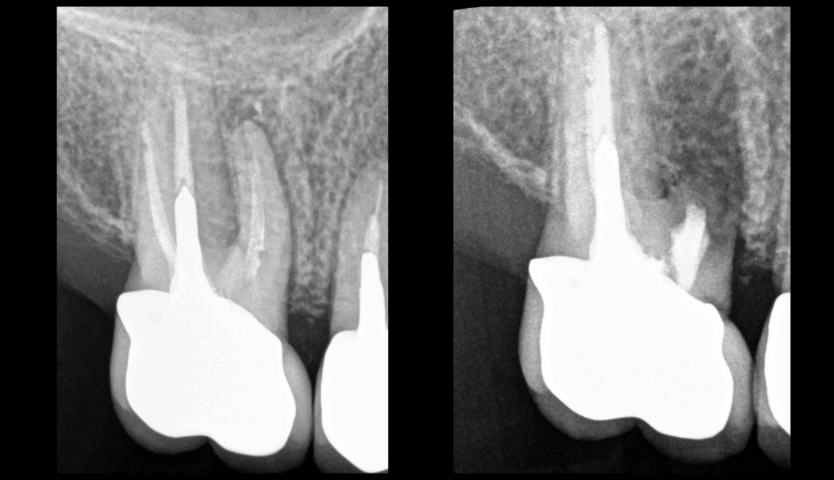 BLOG - Dr Brice Riera - Cas quasi amputation radiculaire