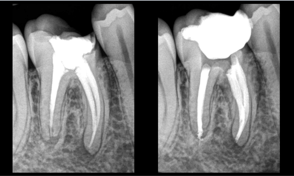 BLOG - Dr Brice Riera Endodontie Paris - lorsqu il manque un canal.